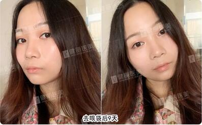超声波去眼袋去掉多年眼袋的我，终于敢大胆晒素颜照了！