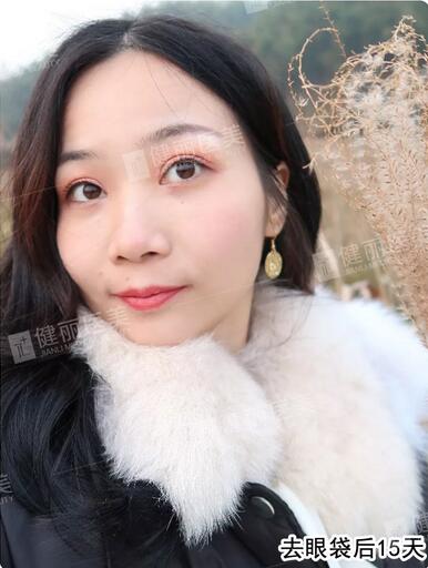 超声波去眼袋去掉多年眼袋的我，终于敢大胆晒素颜照了！
