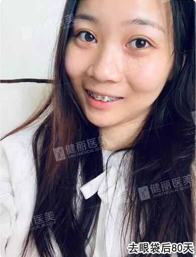 超声波去眼袋去掉多年眼袋的我，终于敢大胆晒素颜照了！