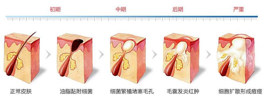 激光调节痤疮果好吗?术后该注意哪些?