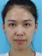 西之米整形医院案例：真人隆鼻对比变身晋魏美女 width=