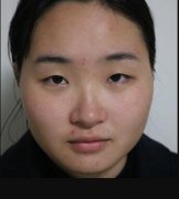 武汉江小美割双眼皮怎么样：真人案例对比衰女变萝莉菇凉 width=