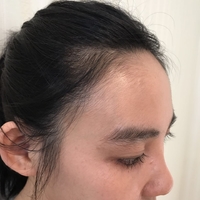 卢相勋植发技术如何?发际线太高让我很烦恼