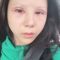 米亚整形眼部手术整形果如何?我也想拥有了自己的大眼睛!