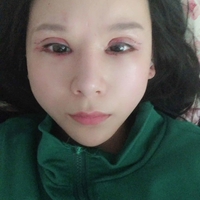 米亚整形眼部手术整形果如何?我也想拥有了自己的大眼睛!
