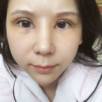 米亚整形眼部手术整形果如何?我也想拥有了自己的大眼睛!