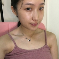 双美胶原蛋白隆鼻价格贵吗?双美胶原蛋白隆鼻果如何?