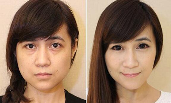 电波拉皮去眼袋果长久吗?