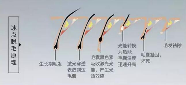 脱毛大作战|这个夏天要你“脱光光”~现在做刚刚好！