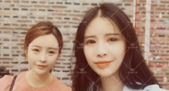 杭州华山连天美全切双眼皮案例：两个闺蜜携手变美的故事 width=