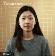 上海艺星切开双眼皮+下巴吸脂前后对比照片 width=