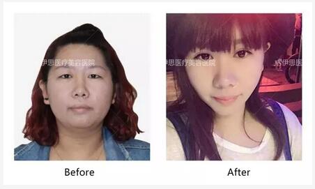 双眼皮、水光、玻尿酸、隆鼻有多疼？来听听5位女孩的亲身感受~