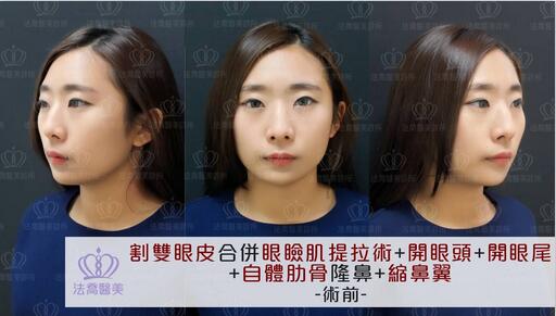 邱浚彦开眼尾+割双眼皮+隆鼻案例，这位美铝涅槃重生？！