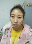 上海美联臣医院垫鼻梁隆鼻前后对比图：改头换面的开始 width=