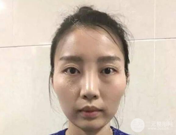 磨颧骨前后对比图，从此爱上了自拍