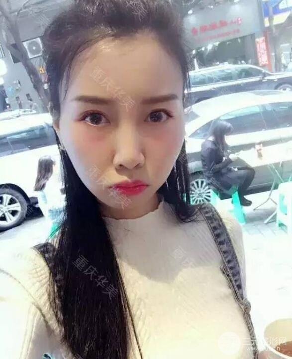 磨颧骨前后对比图，从此爱上了自拍