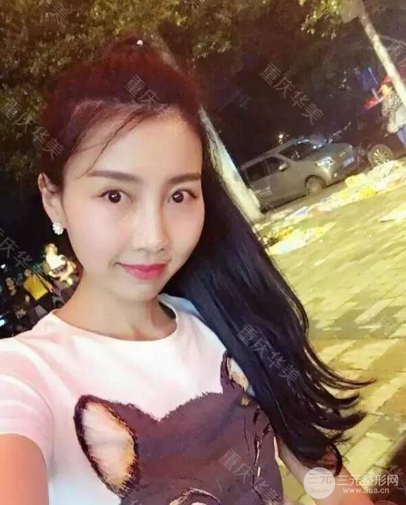 磨颧骨前后对比图，从此爱上了自拍