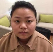 武汉伽美整形医院面部吸脂瘦脸对比图：大饼脸的春天 width=