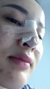 蒋松林仿生隆鼻真人案例前后对比图分享：终于有了高鼻子 width=