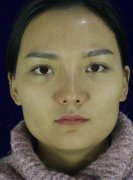 下颌角整形对比照片真实案例：134天变心动女生 width=
