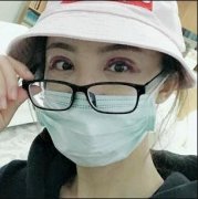 张姣姣韩式微创双眼皮前后对比图：84天喜提大眼仔 width=
