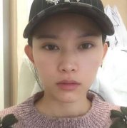 分段式假体隆鼻前后对比图：鼻孔外露也没有辣~ width=