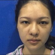伊美尔隆鼻价格：假体隆鼻前后对比图一共花了2万8 width=