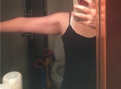 厦门银河整形手臂吸脂去除蝴蝶臂前后对比图真人分享 width=
