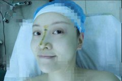 厦门银河整形隆鼻梁全过程恢复直播：塌鼻子的华丽转身~ width=
