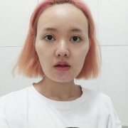 自体面部填充全脸前后对比图：年轻化超好的方法 width=