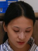 肋骨隆鼻果图：62天前后对比皂片 width=