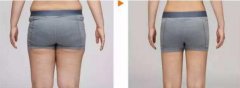 腰部吸脂减肥有什么优势? width=
