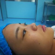 青岛美林苑做鼻部手术手术的恢复日扎：内附价目表 width=