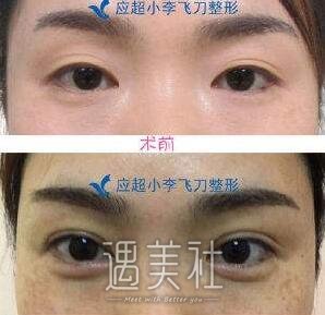 贵阳小李飞刀整形医院怎么样?李作勇院长技术如何?