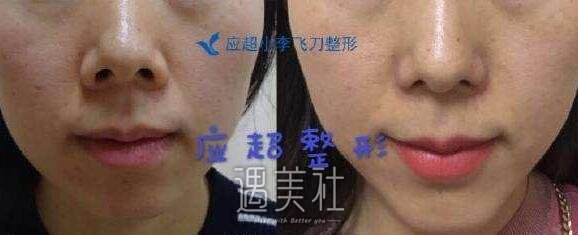 贵阳小李飞刀整形医院怎么样?李作勇院长技术如何?