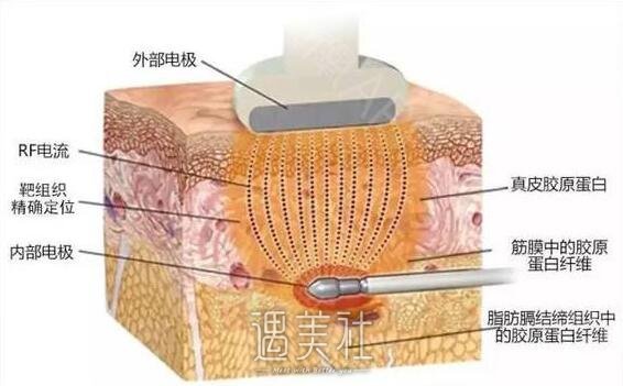 像素射频除皱做一次就可以了吗?做一次能保持多久?