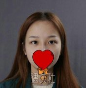 杨明勇双眼皮案例图片：你想要的眼型都可以哟~ width=