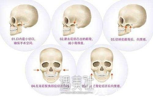 磨腮削骨恢复期到底有多长?怎样才能想要的果?