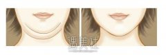 超声吸脂去双下巴有没有果了?不要做无用功~ width=