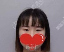 项利姣双眼皮案例展示，项利娇医生的技术真不错! width=