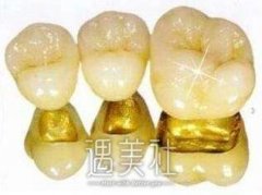 黄金烤瓷牙的价格高吗?果好不好? width=