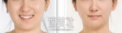 去双下巴使用超声吸脂果快来了解一下! width=