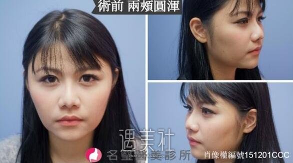 口腔去颊脂垫体验去除BABY FAT变身成熟气质OL width=