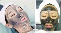 黑脸娃娃去黑头果肿么样，能拔干净吗? width=