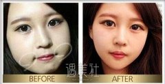 面部吸脂和去颊脂垫哪个好?傻傻的分不清! width=