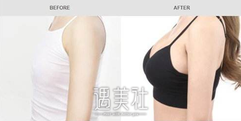 妙桃琴面假体隆胸的价格是多少?价格会是我能够承担得起的吗?