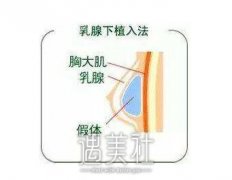 双C双平面丰胸是什么，做出来是个啥郊果? width=