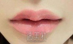 胶原蛋白丰唇多少钱，影响手术费用的是什么? width=
