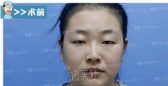 厦门修志夫双眼皮案例|天生肿泡眼的成功改造~ width=