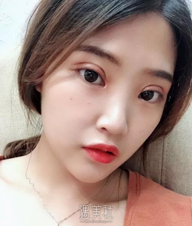 百嘉丽侯亚杰做双眼皮怎么样?真实案例展现其好技术!